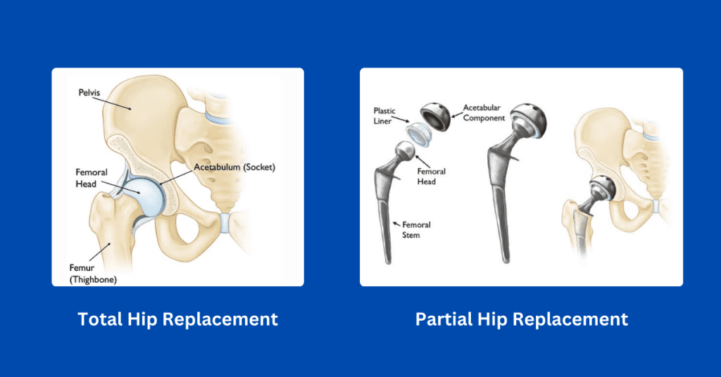 Hip Replacement Surgery in Jaipur - Dr. Deepesh Ameriya